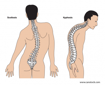 Scoliosis_Kyphosis Back